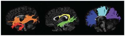 Prenatal tobacco and alcohol exposure, white matter microstructure, and early language skills in toddlers from a South African birth cohort